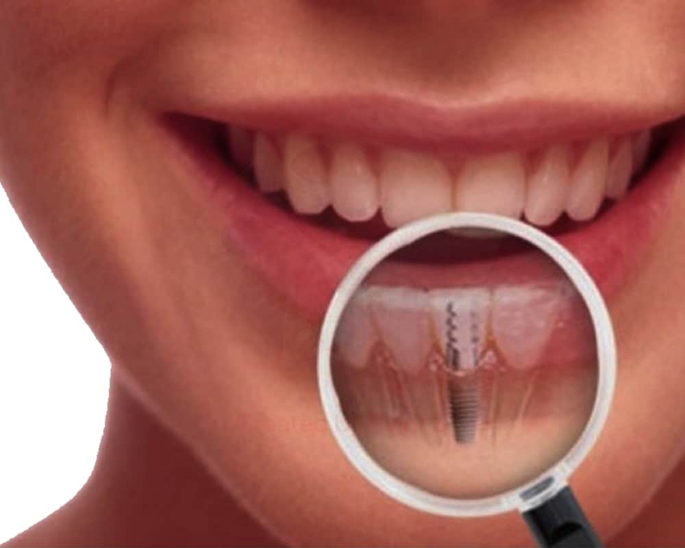 imagen de implantes dentales clinica lanchares