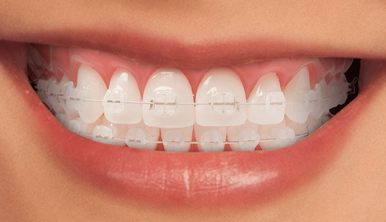 imagen de ortodoncia estetica brackets clinica dental moratalaz